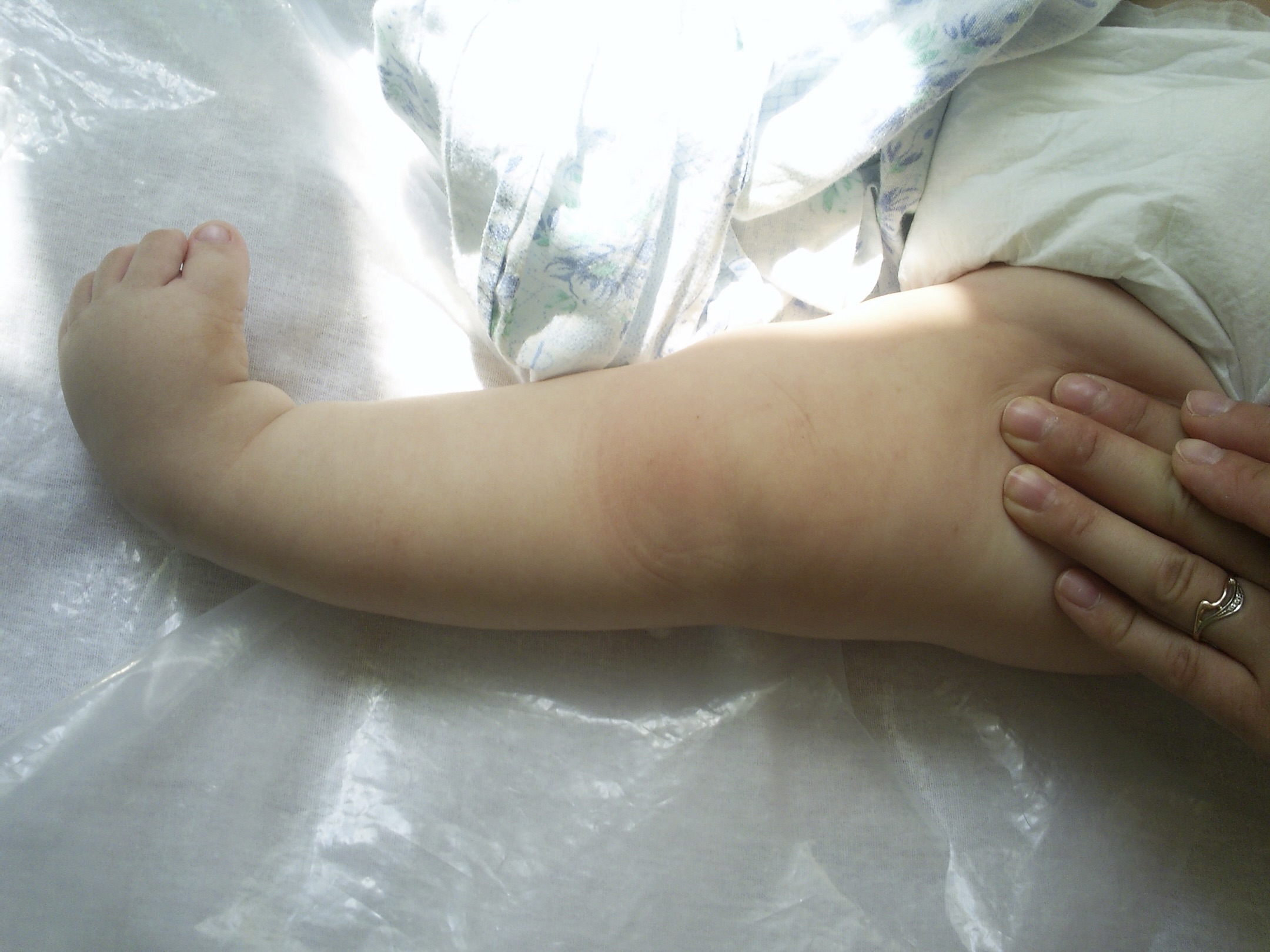 Кировские врачи спасли младенца с врожденной косолапостью