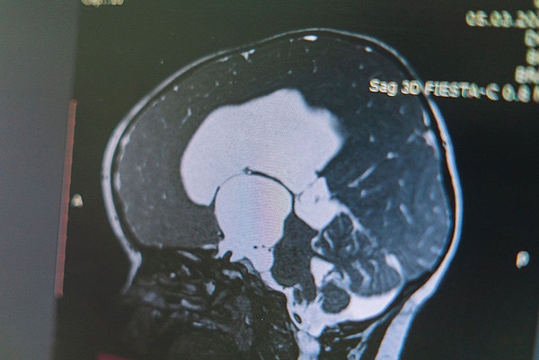 "Путем вмешательства в мозг": кировские врачи спали 1,5-годовалого малыша от патологии 