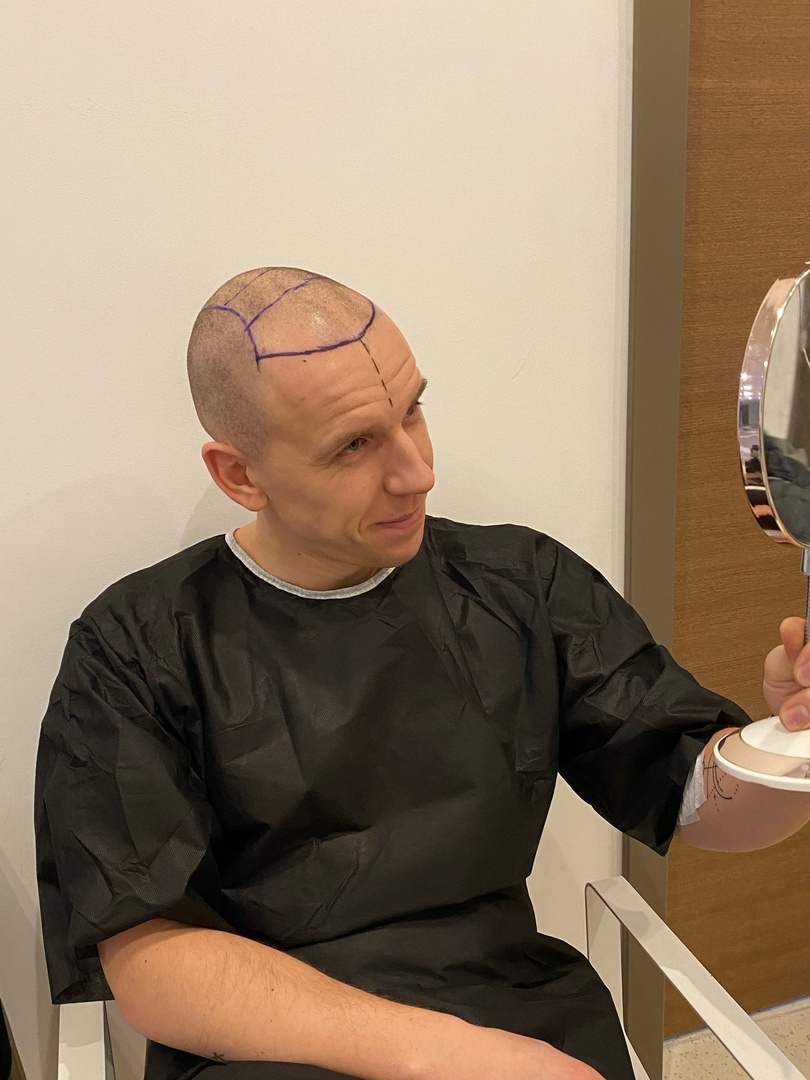 Семичасовая операция и уколы в голову: кировский ведущий сделал пересадку волос