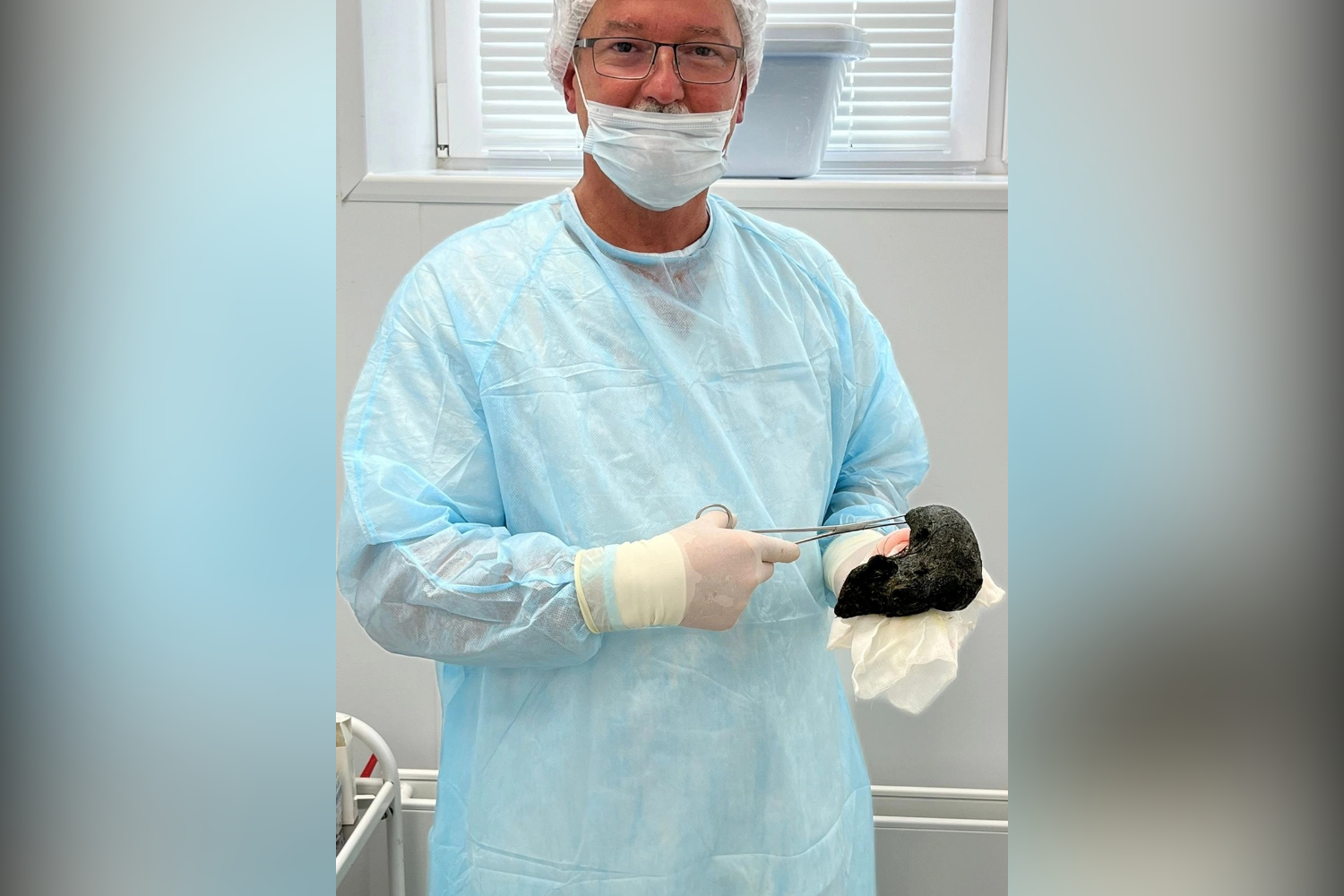Кировские хирурги удалили огромный комок волос, занявший весь желудок пациентки
